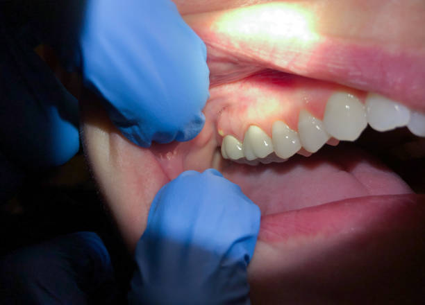 Best Chipped Tooth Repair Near Me  in Conway, FL